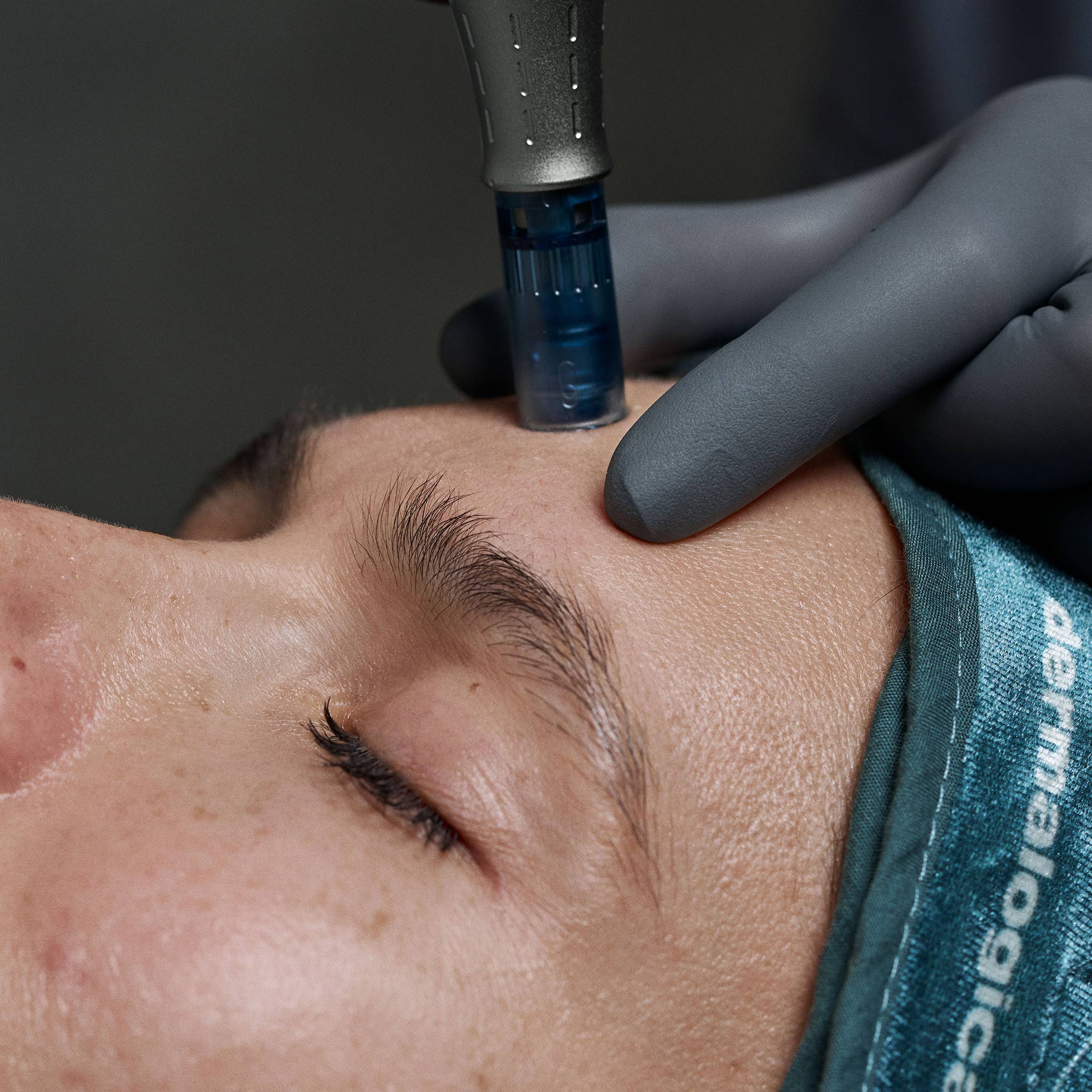 pro microneedling